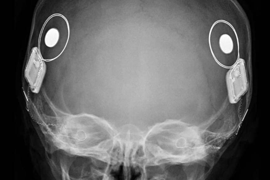 implante auditivo gratuito